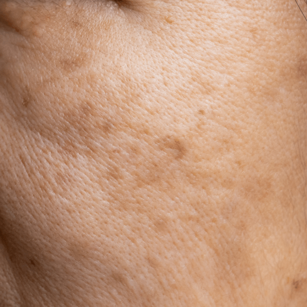 Melasma