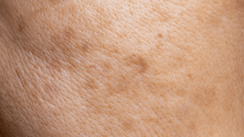 Melasma