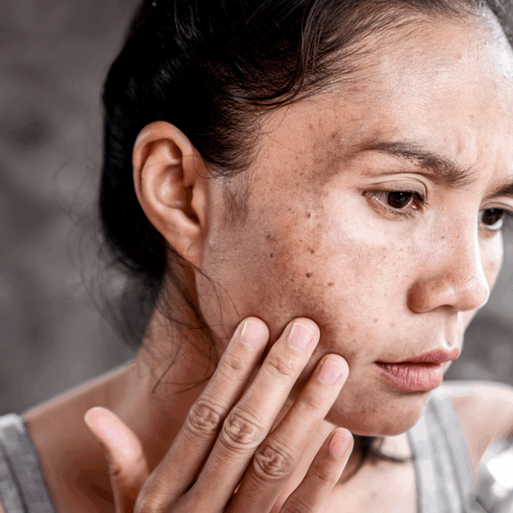 Pigmentation