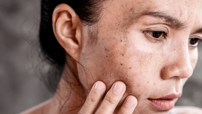 Pigmentation