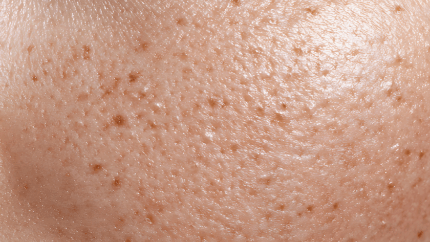 Congested Pores