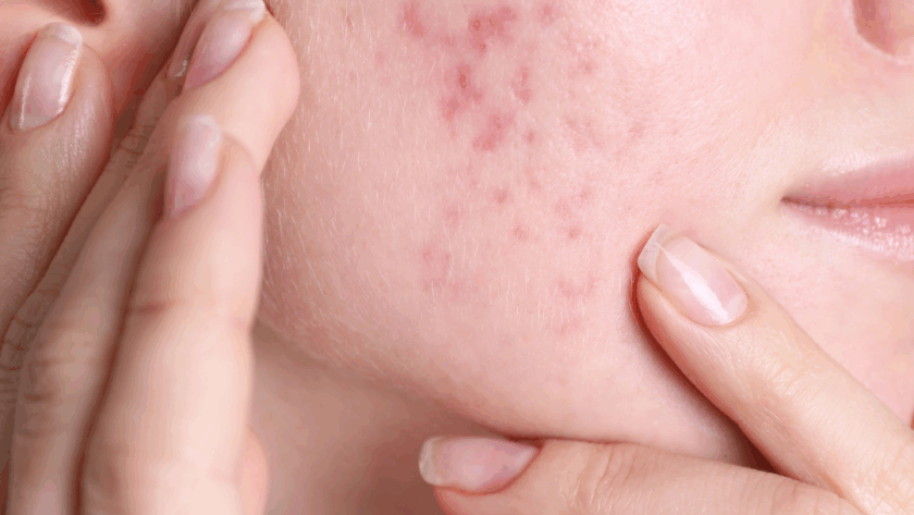 ACNE SCARRING