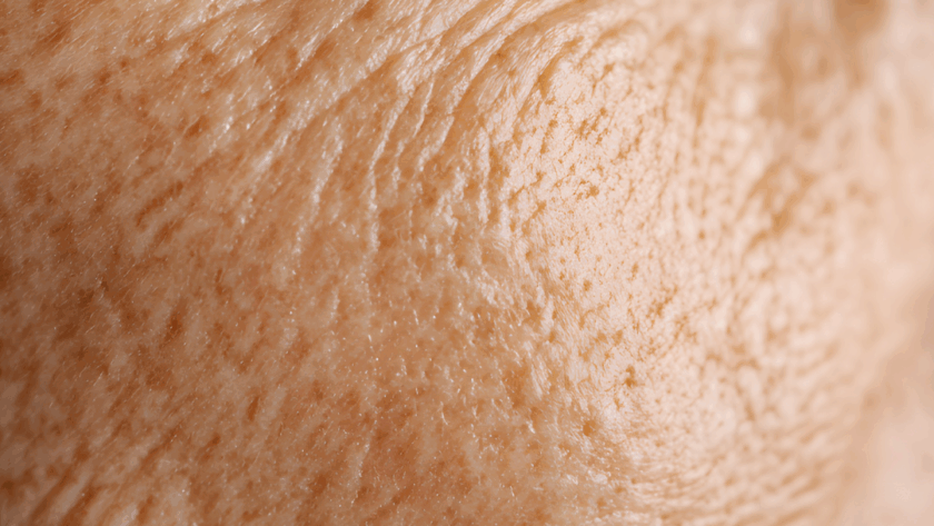 Wrinkles